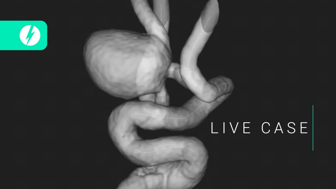 10mm size MCA aneurysm - SLICE Next Frontiers 2022 - Annie JOB