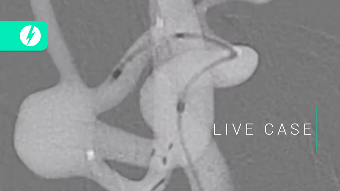 Endovascular treatment of MCA - SLICE Next Frontiers 2022 - Julien CIAGAR